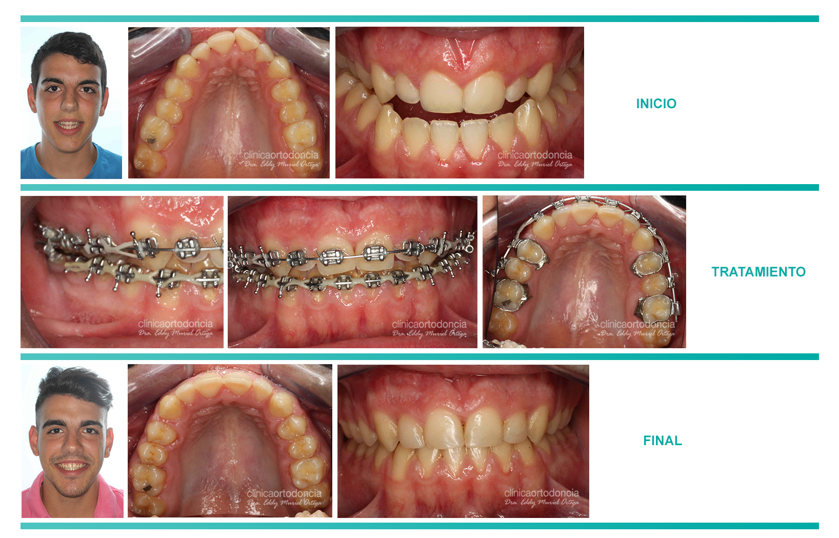 Fases de la ortodoncia en el segundo caso quirúrjico