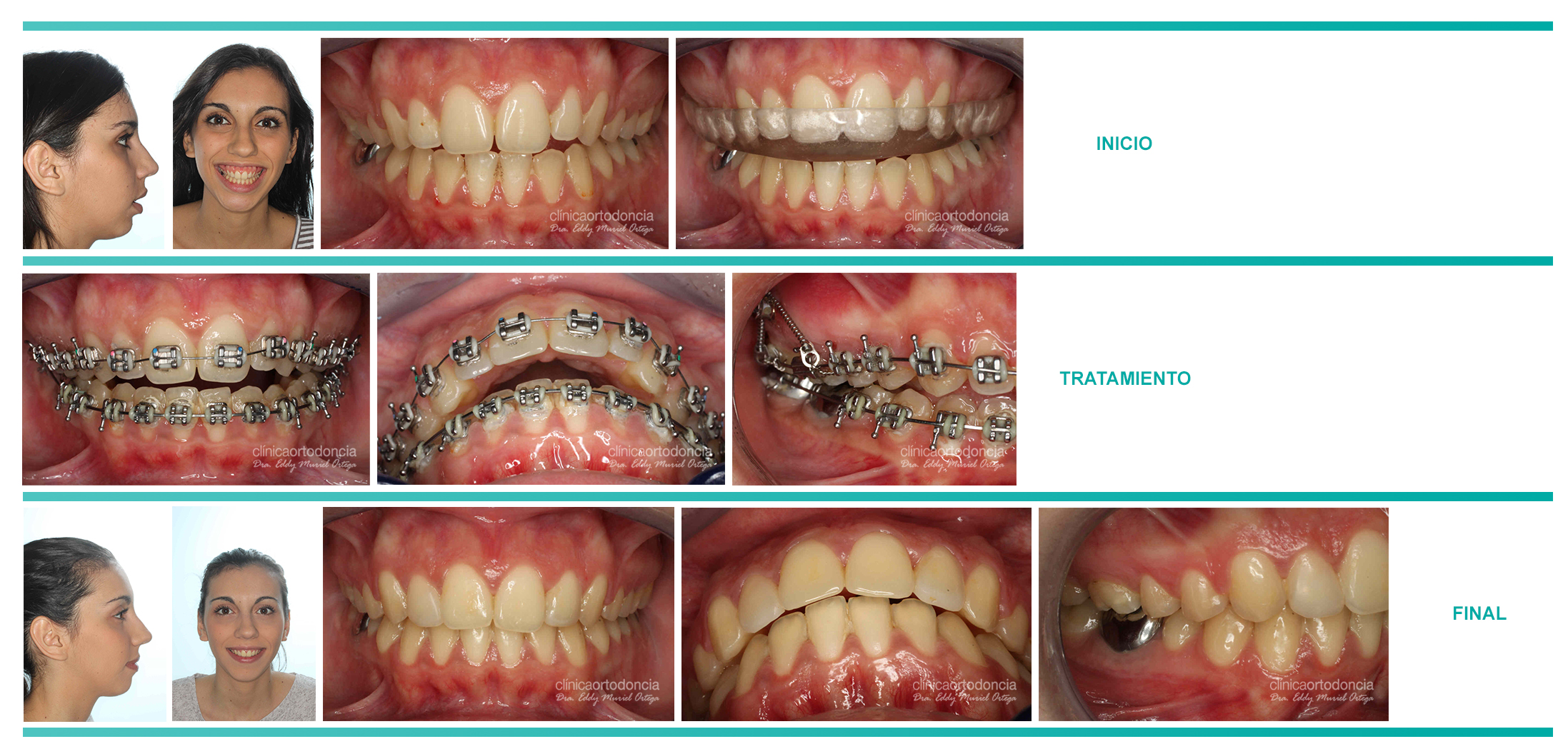Fases de la ortodoncia en caso clínico complejo