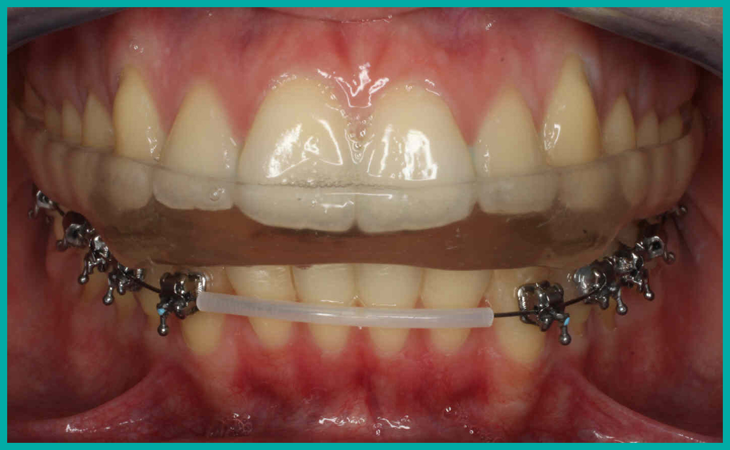 Dispositivo del tratamiento colocado en los dientes